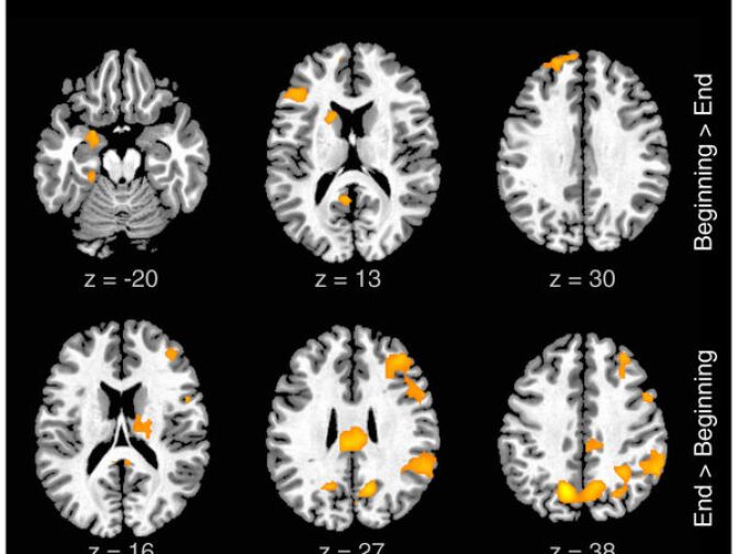 Activations associated with evolution of improvisation in time: Activity selectively related to improvisation at the beginning vs. the end of each 8 bar segment is illustrated.