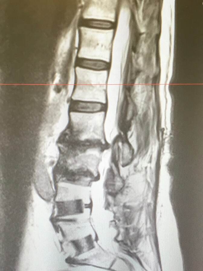 An MRI showing Jan Curtis's damaged spine. Curtis suffered chronic pain for more than a decade. She had surgery for degenerative disc disease in 2017.