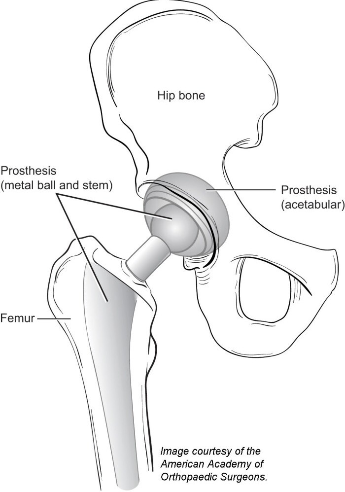 A diagram of a total hip replacement.