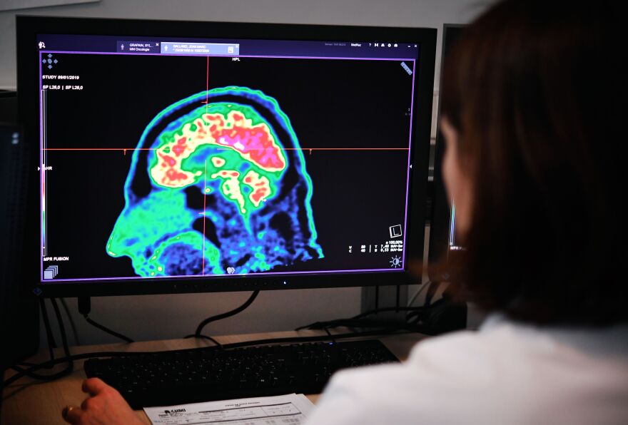 A picture of a human brain taken by a positron emission tomography scanner, also called PET scan, is seen on a screen on January 9, 2019, at the Regional and University Hospital Center of Brest (CRHU - Centre Hospitalier Régional et Universitaire de Brest), western France. - The CHRU of Brest has just acquired a new molecular imaging device, the most advanced in France today according to the hospital center, capable of better detecting deep lesions and especially cancerous pathologies, the hospital announced on January 9, 2019. (Photo by Fred TANNEAU / AFP)        (Photo credit should read FRED TANNEAU/AFP via Getty Images)