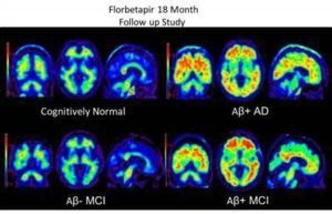 Brain scans using Amyvid dye to highlight beta-amyloid plaques in the brain. Clockwise from top left: a cognitively normal subject; an amyloid-positive patient with Alzheimer's disease; a patient with mild cognitive impairment who progressed to dementia during a study; and a patient with mild cognitive impairment.