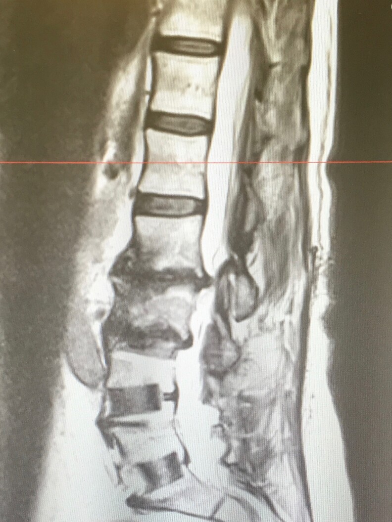 An MRI showing Jan Curtis's damaged spine. Curtis suffered chronic pain for more than a decade. She had surgery for degenerative disc disease in 2017.