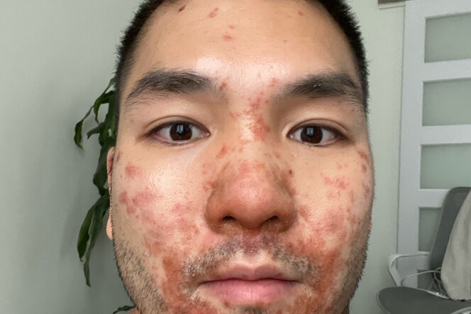 A man with a rash looks at the camera. 