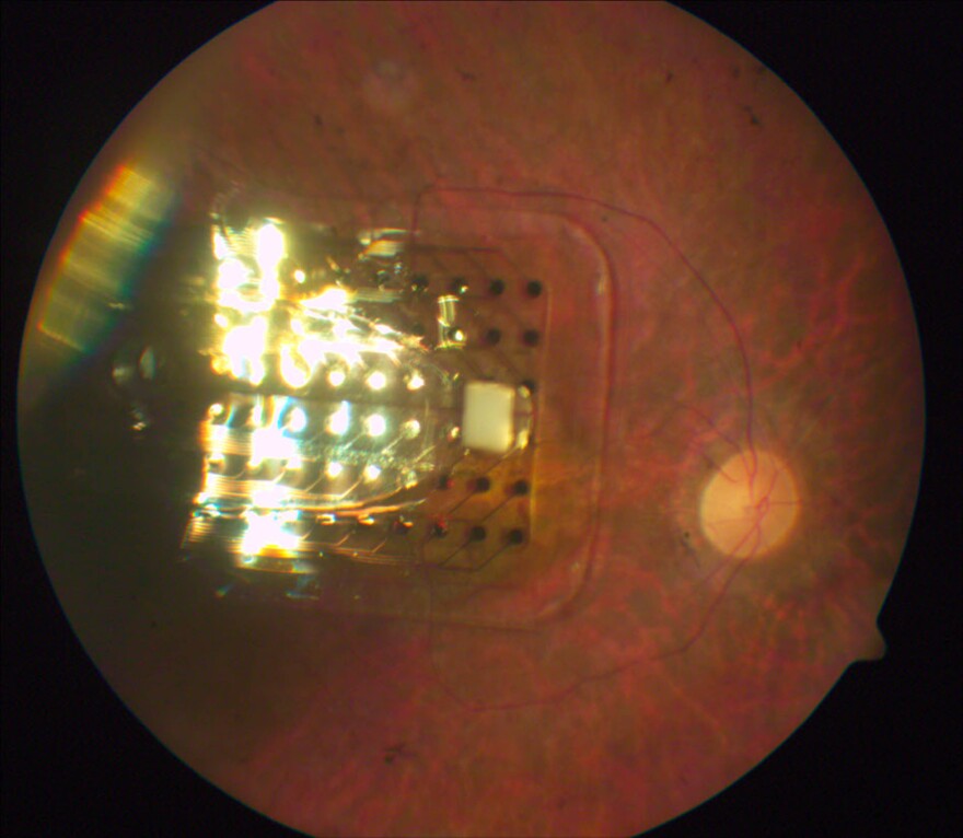 An image of an Argus implant on the retina of an eyeball.