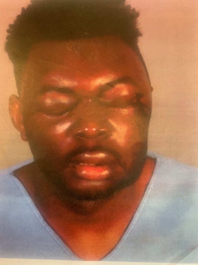 Christopher Bailey's face is bruised and his eyes appear swollen shut.