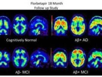Brain scans using Amyvid dye to highlight beta-amyloid plaques in the brain. Clockwise from top left: a cognitively normal subject; an amyloid-positive patient with Alzheimer's disease; a patient with mild cognitive impairment who progressed to dementia during a study; and a patient with mild cognitive impairment.