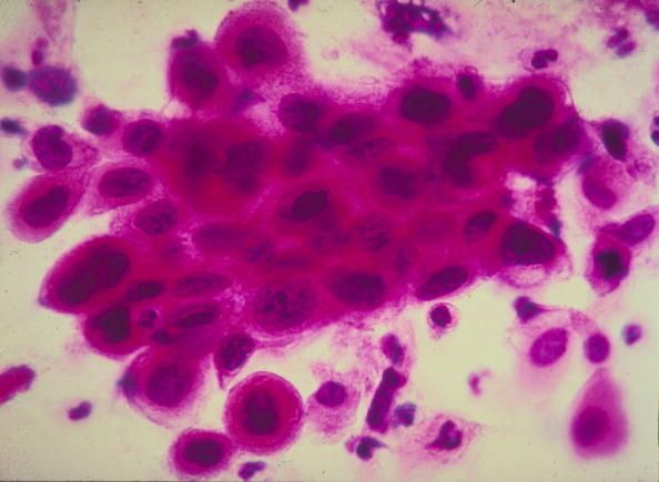 File photo: Close up of cancer cells in the cervix. CIRM awarded UCLA $20 million for the university's study on the reprogramming of cancer cells.