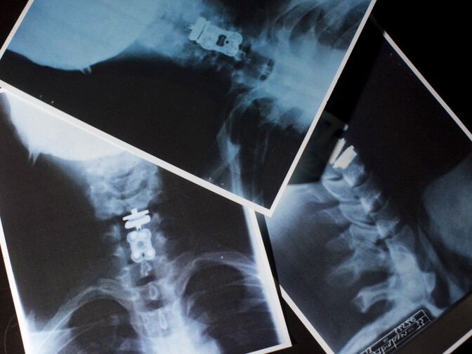 Photocopies of X-Rays show the metal plate and spacer in the front of Abraham Pena's neck. 