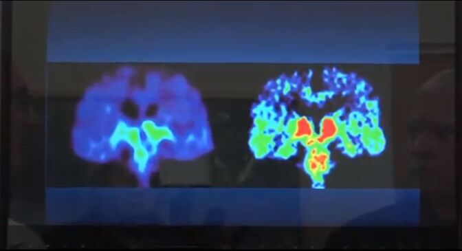 Image of a brain scan taken during a UCLA study on brain injuries in living former NFL players. 