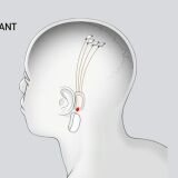 Neuralink's N1 Implant