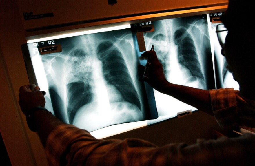 A doctor is in a darkened room, holding an x-ray at arm's length and examining it for signs of TB. There are several other x-rays lined up alongside it, all backlit to show the imaging contrasts.