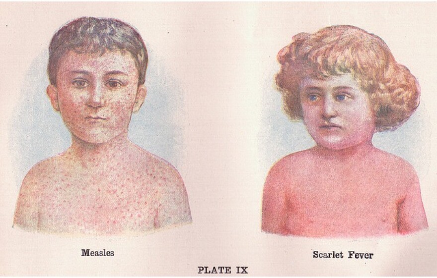 measles.jpg