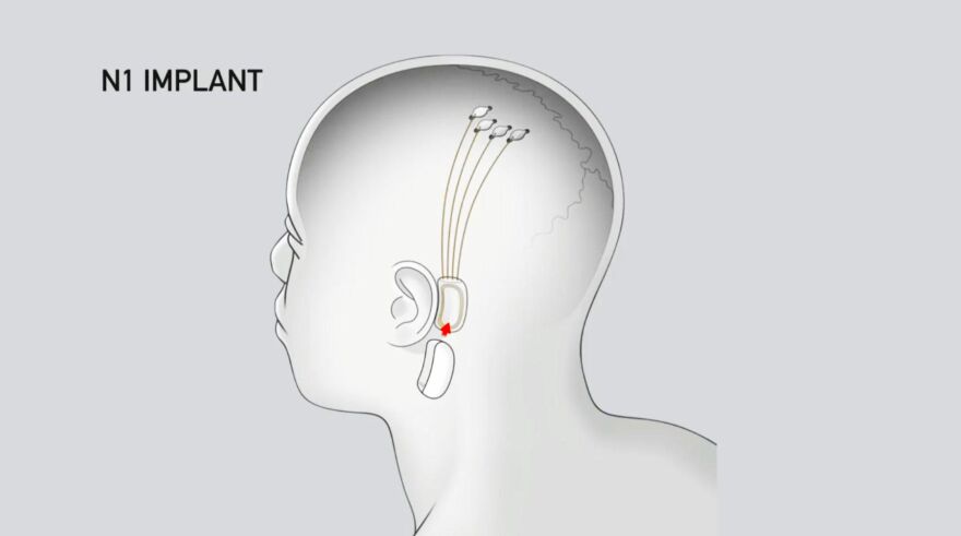Neuralink's N1 Implant