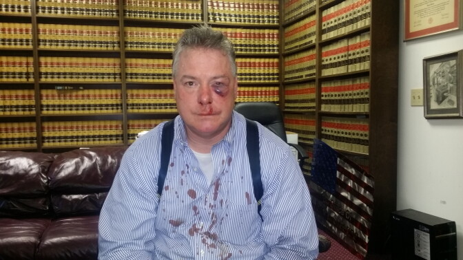 Court-appointed private attorney James Crawford suffered from fractured sinuses after he was allegedly attacked by an Orange County district attorney investigator.