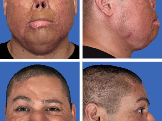Retired Marine Staff Sgt. Octavio Sanchez, before and after reconstructive surgery