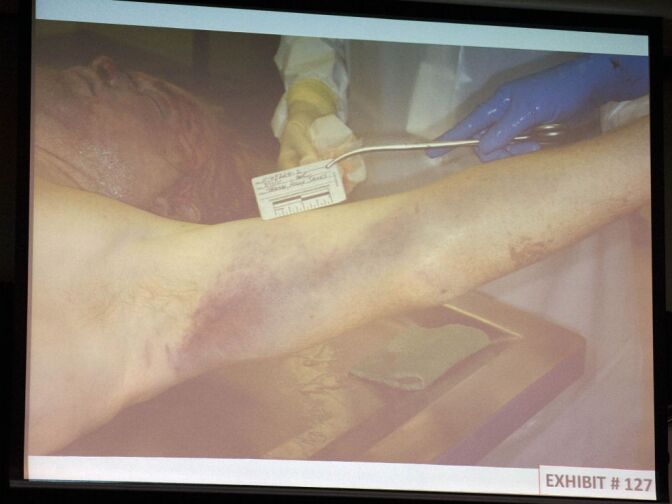 A medical examiner's photograph shows various wounds on Kelly Thomas' body at the time of autopsy.