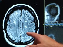 In a new survey by Ronald Reagan UCLA Medical Center, people under the age of 45 were asked what they would do in the first 3 hours of experiencing symptoms of a stroke. A majority of the respondents, 73 percent, said they would put off going to the hospital and would instead likely wait to see if they felt better.