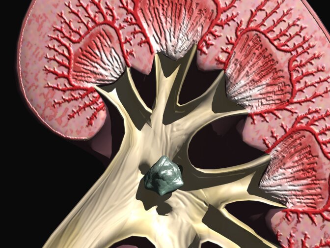 This computer illustration shows a kidney stone in the renal pelvis. Although a major  component of kidney stones is calcum, a new study shows that a calcium-rich diet  may help inhibit their development.