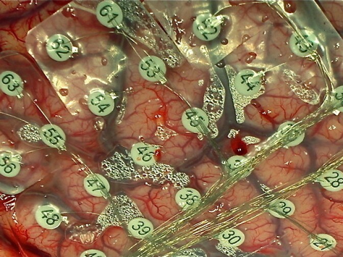Surgeons use a grid of electrodes laid on a patient's brain. They record electrical activity and can deliver a tiny jolt.
