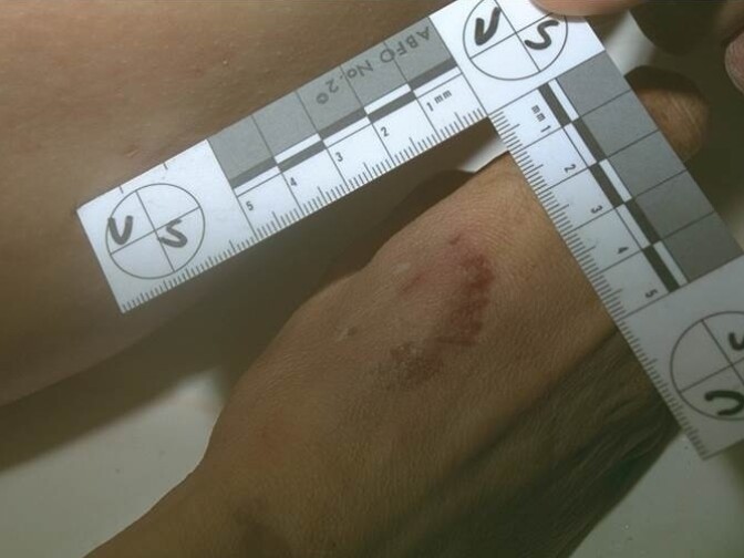 A jury convicted Richards after a photo of what was thought to be a bite mark on the victim's hand was submitted as evidence at trial.