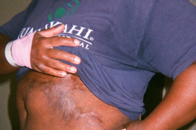 A photo of Trina's burn scars on her abdomen.