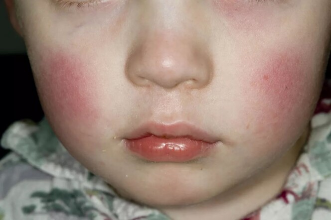 A young child with rosy cheeks and crusty flecks of skin pealing off 