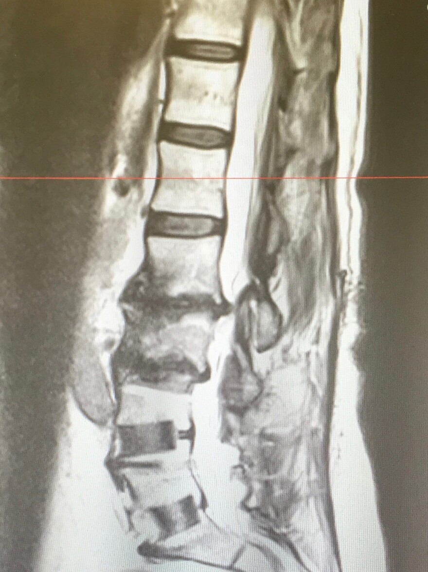 An MRI showing Jan Curtis's damaged spine. Curtis suffered chronic pain for more than a decade. She had surgery for degenerative disc disease in 2017.