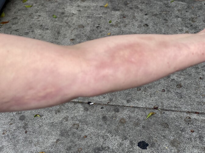 Taylor's arm is outstretched showing bruising she said she received from her spouse.